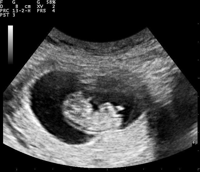 ultrasound